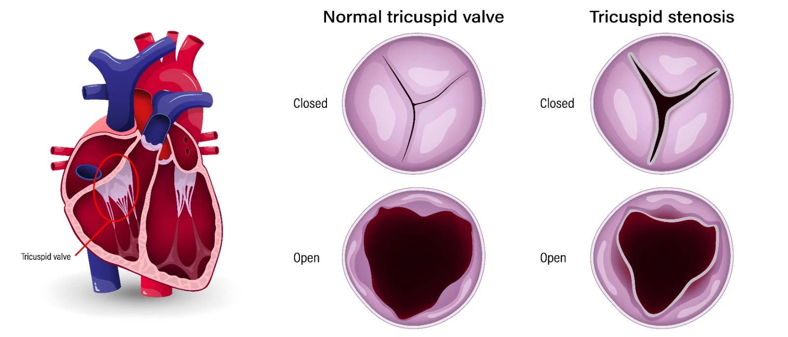 Tricuspid Valve Diseases