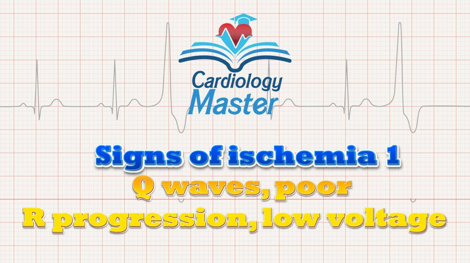 2. Signs of ischemia, Q waves, poor R, low voltage