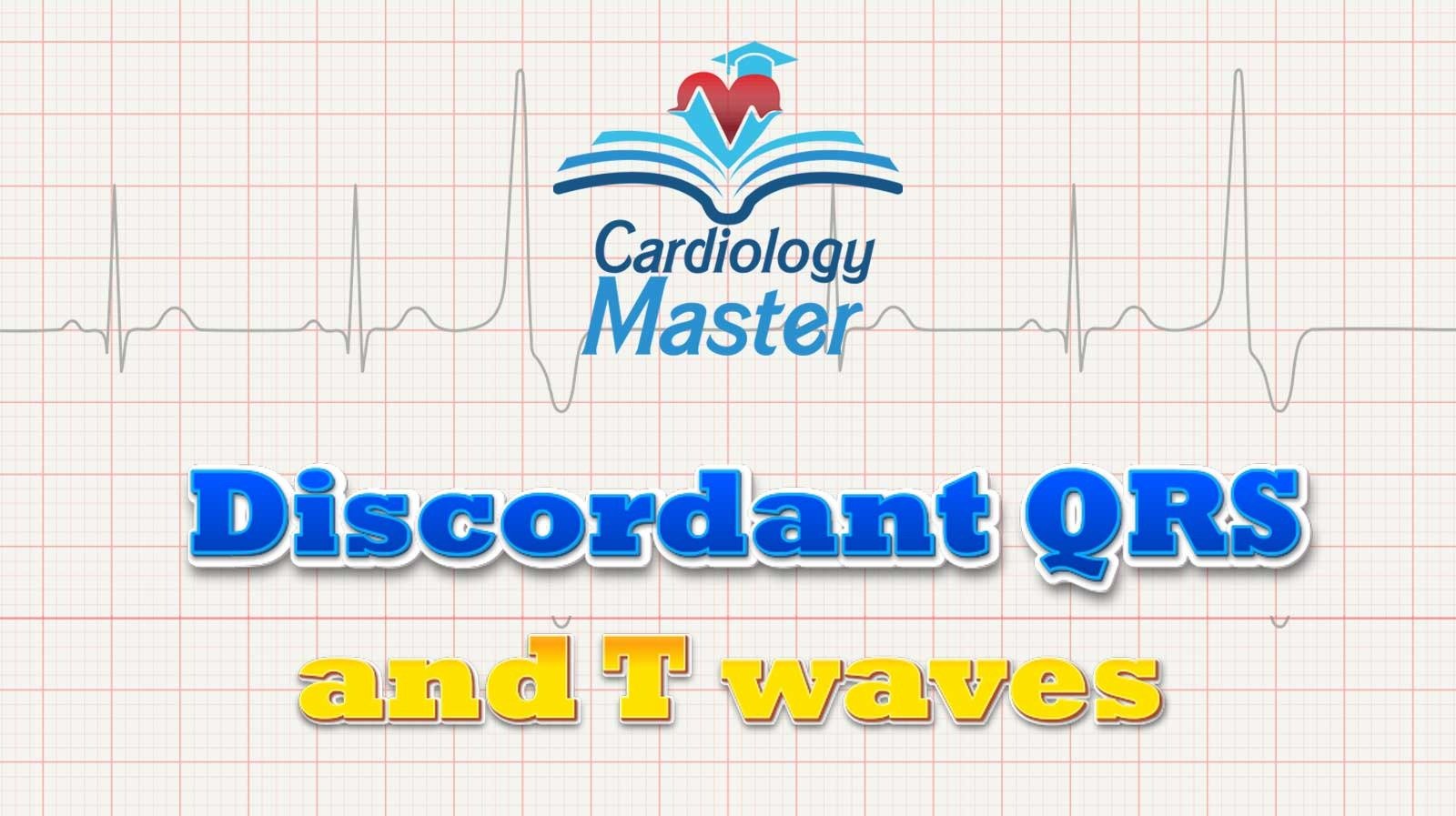 5. Discordant QRS and T waves