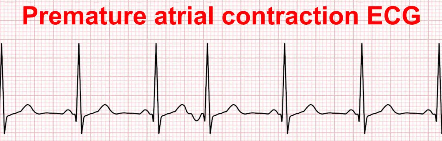 Premature Atrial Contractions (PAC) Diagnosis