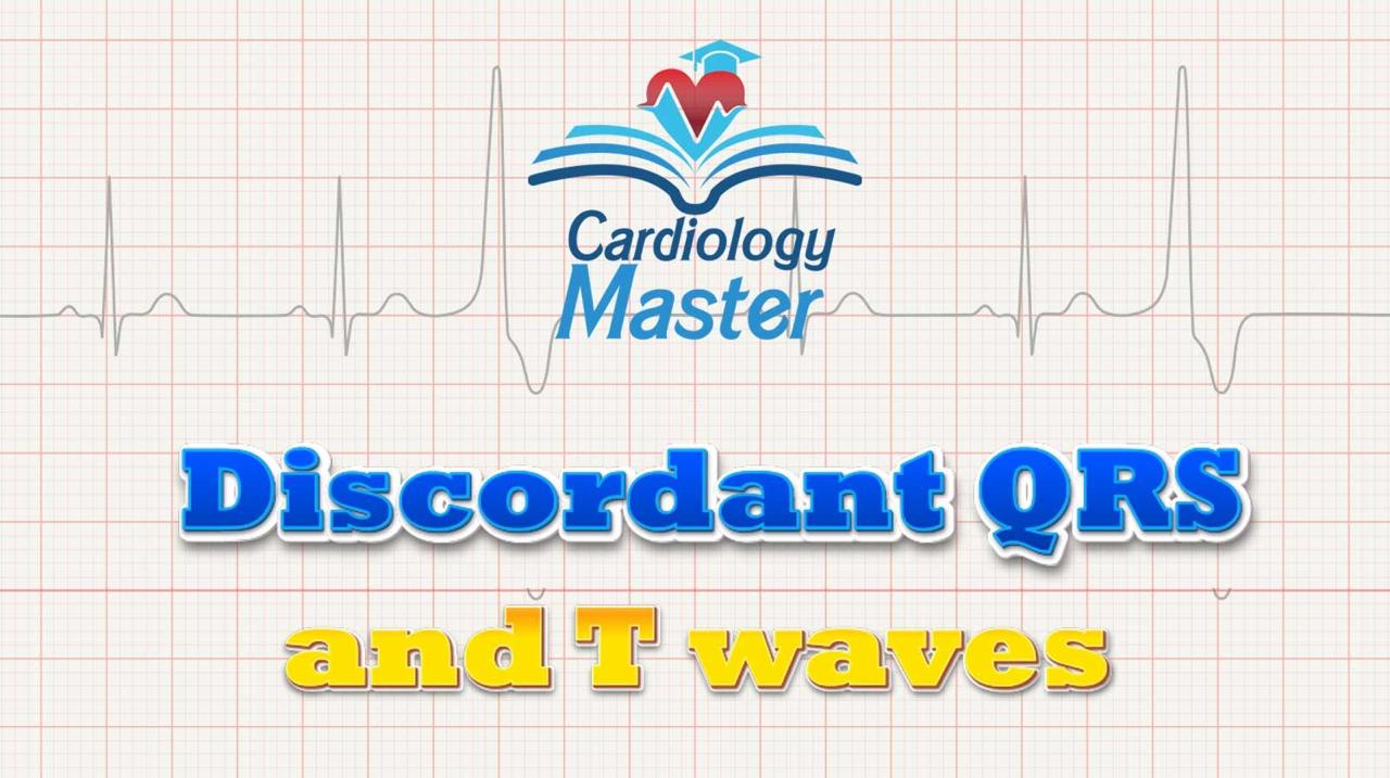 5. Discordant QRS and T waves