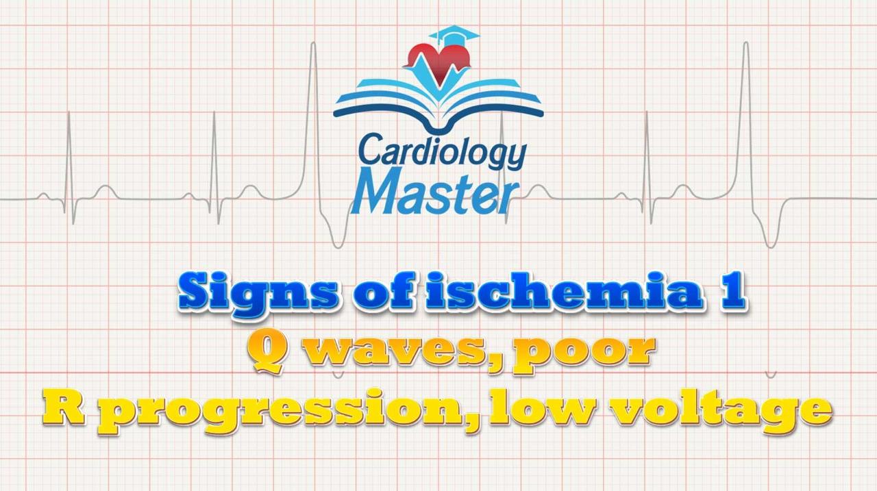 2. Signs of ischemia on the ECG