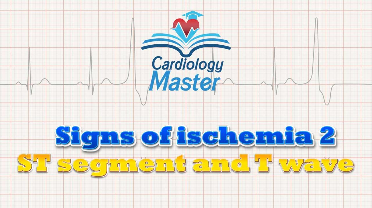 3. Signs of ischemia, the ST segment changes