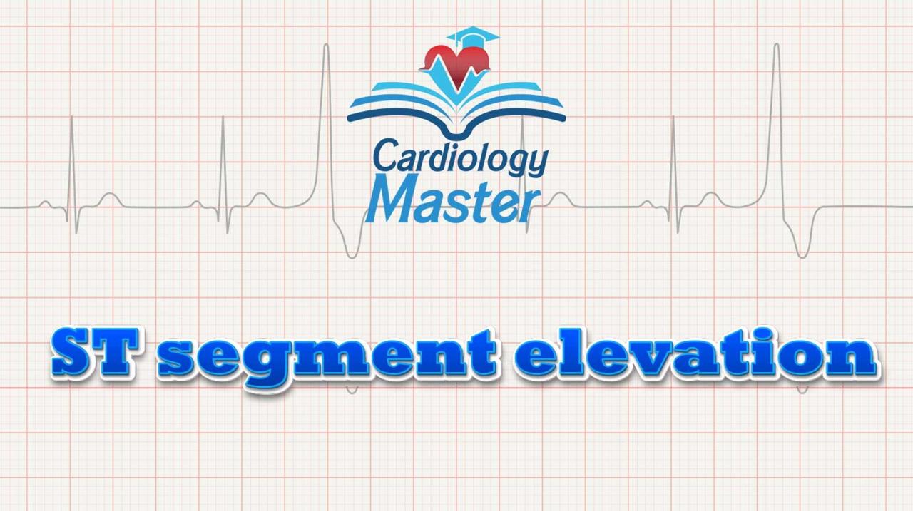 4. ST segment elevation