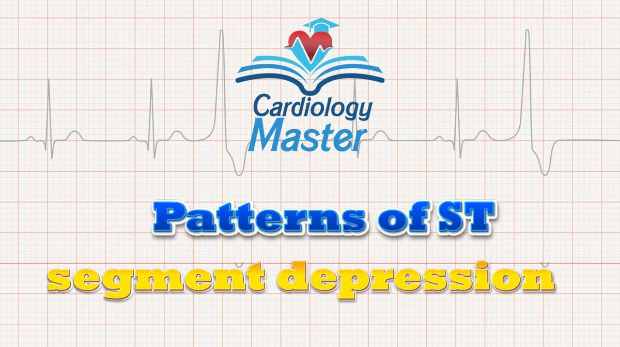 Patterns of ST elevation